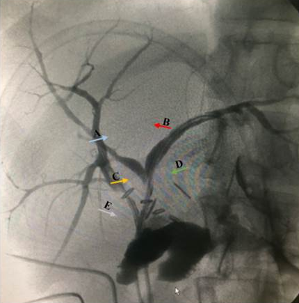 Figura 1: Colangiografia intraoperatoria